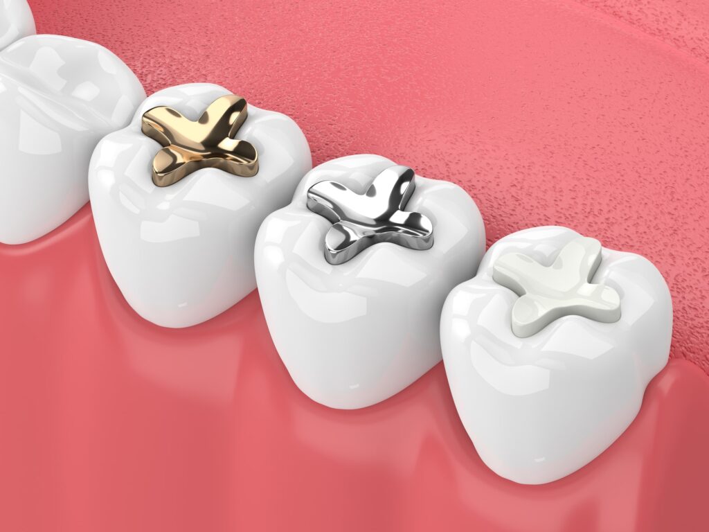 A 3D illustration showing different types of dental fillings, including gold and silver amalgam, on back teeth.