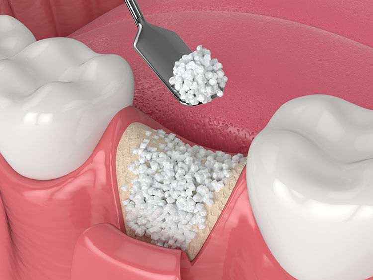 A close-up illustration of a bone graft being placed in the jawbone to support a future dental implant.
