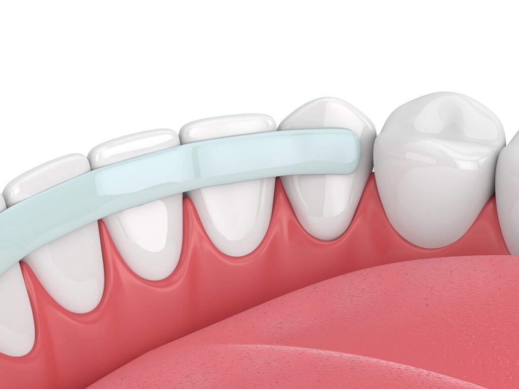 A 3D-rendered image demonstrating dental bonding being applied to the bottom row of multiple teeth
