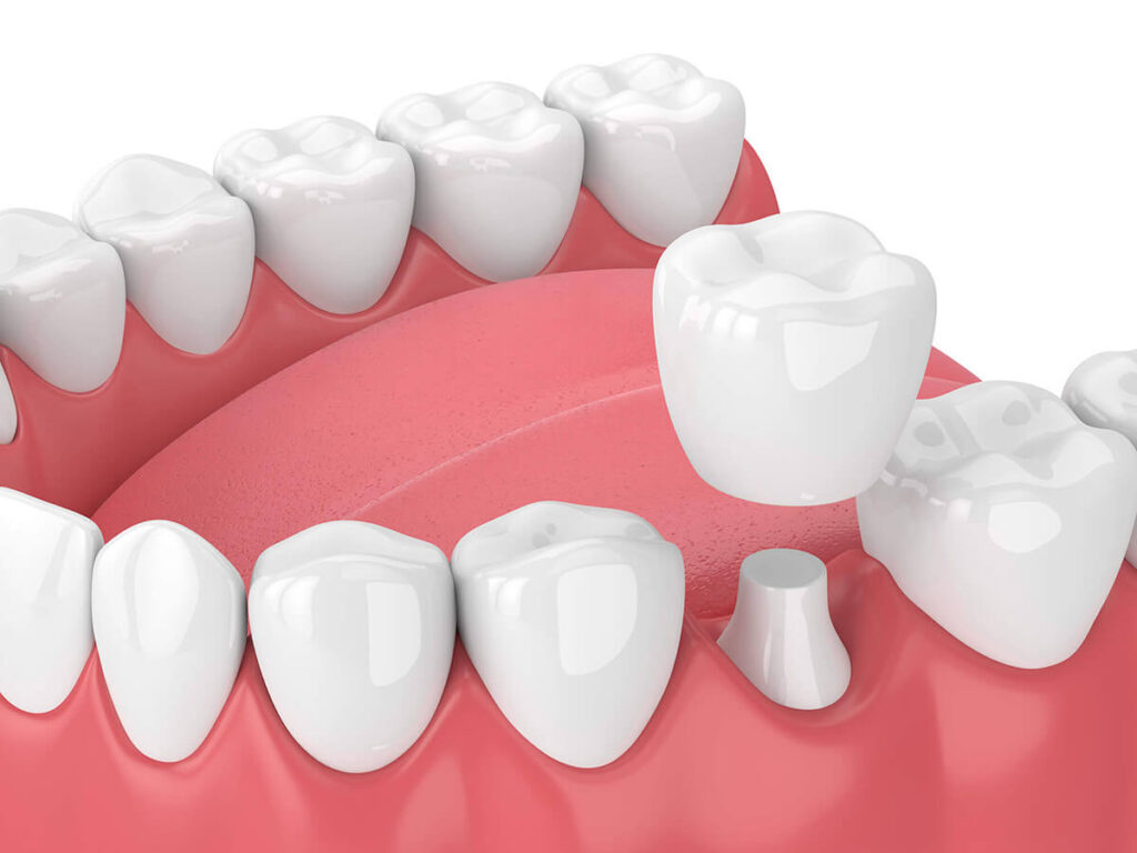 3D model showing a traditional dental bridge being placed over adjacent teeth for support.