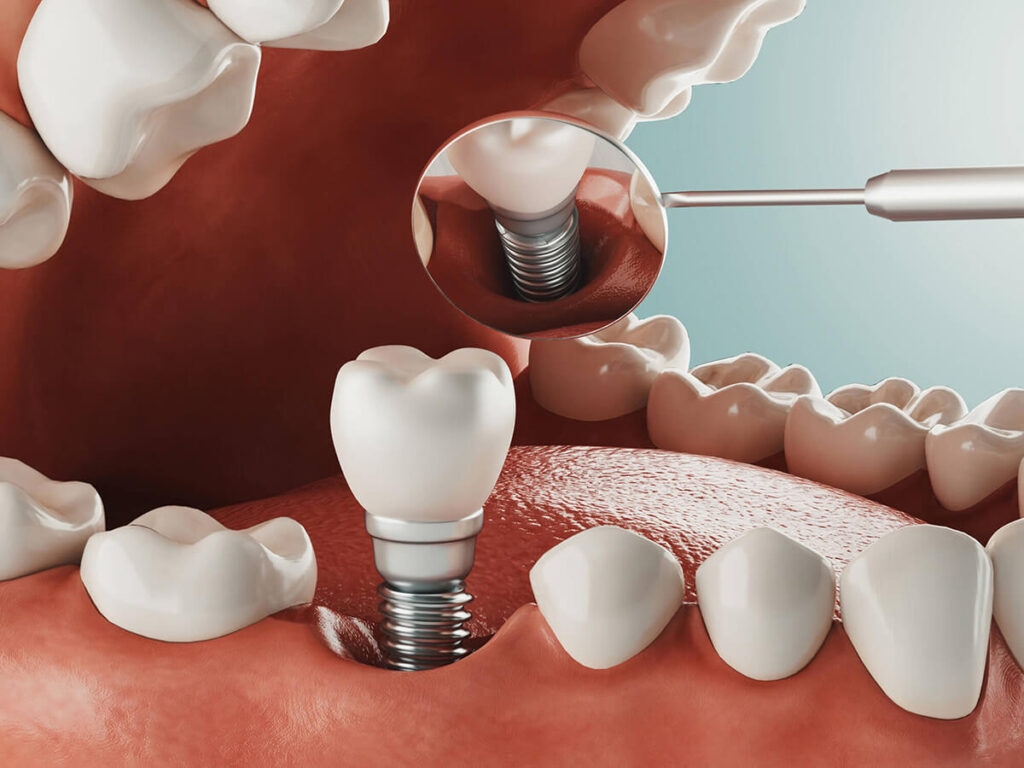 A 3D-rendered image showing a dental implant being placed into the gum with a mirror reflecting the surrounding teeth.