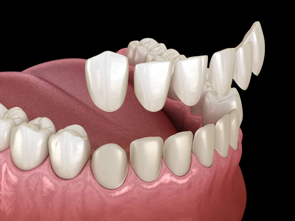 A digital rendering showing thin porcelain veneers being applied to the front of natural teeth.