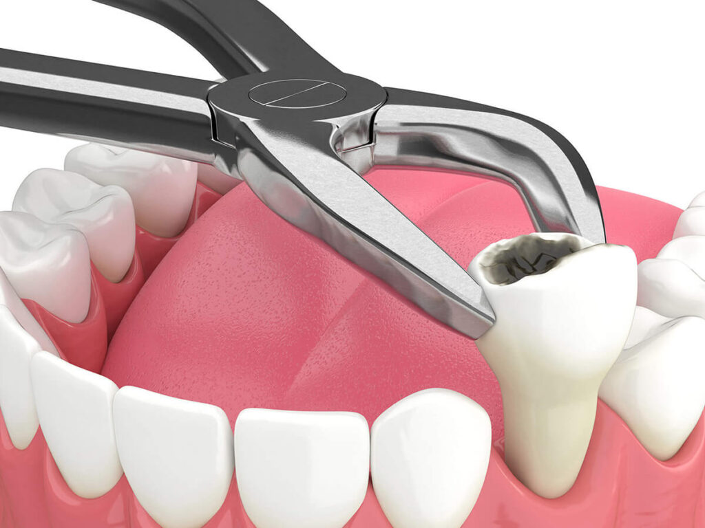 A close-up digital rendering of a dental extraction where forceps are removing a damaged tooth from the gumline.