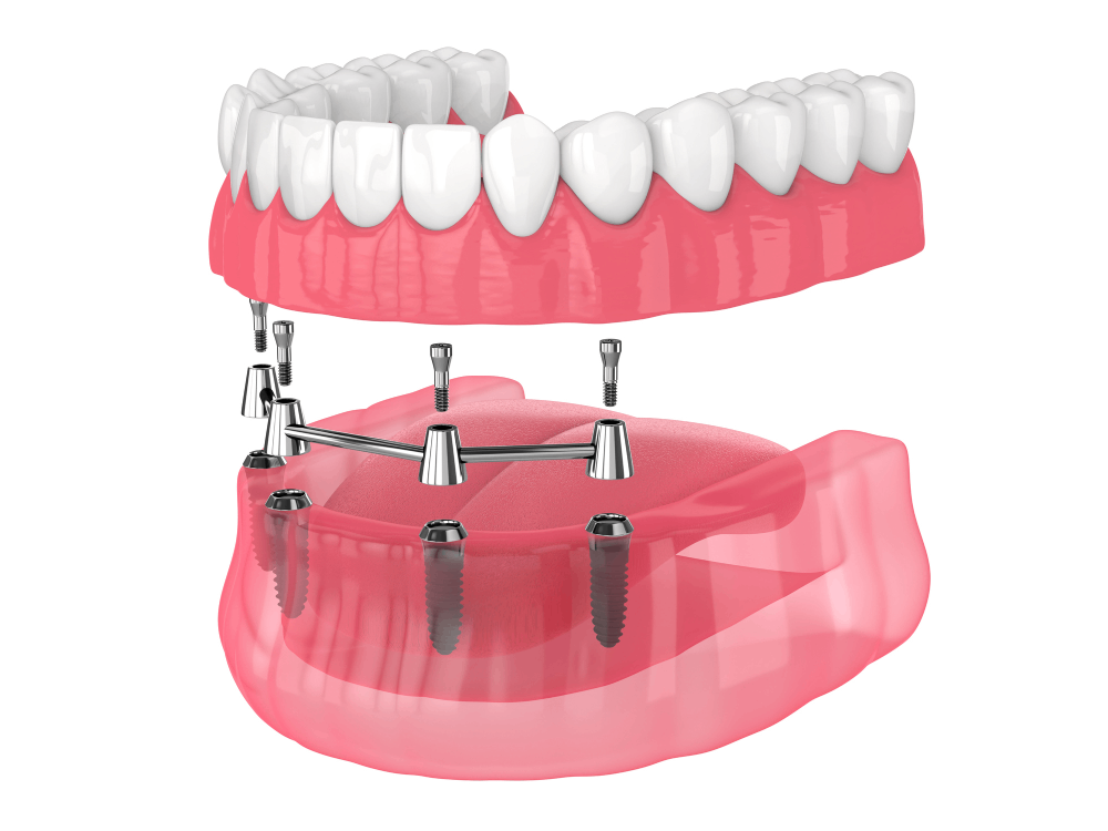 A 3D-rendered image showing an All-on-4 dental implant system with four titanium posts supporting a full-arch prosthetic.