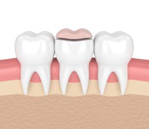 illustration of a dental inlay being applied to the bottom row of teeth
